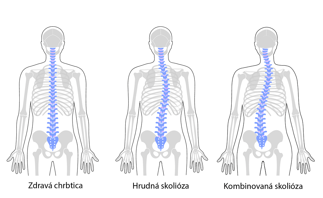 Skolioza 2